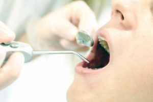 虫歯ができる原因って？～虫歯ができる4つの条件～
