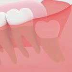 親知らずの抜歯ってどうやるの？～抜歯から治癒まで～