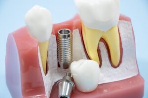 インプラント費用の全貌！～長期的価値を見極める投資判断～